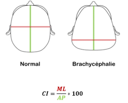 Brachycephalie deformation cranienne kinesitherapeute osteopathe baillargues analyse dysymétrie du crane