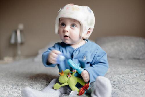 Plagiocephalie craniopole syndrome tete plate bébé port du casque petite enfance baillargues